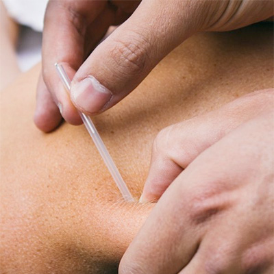 Dry Needling
